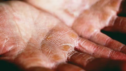 1772693705128433.jpg Eczema.jpg
