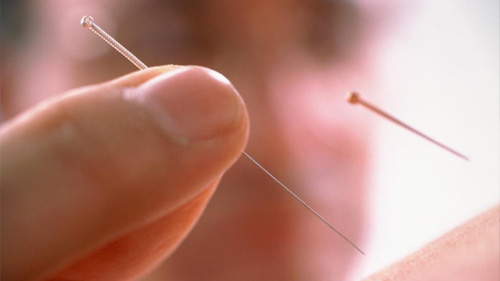 Acupuncture.jpg