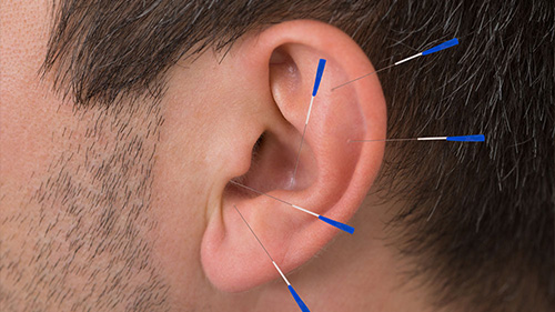 Auricular Acupuncture(ear needle).jpg