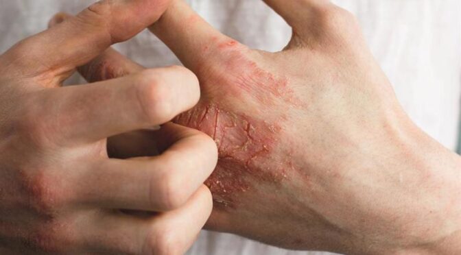 Eczema