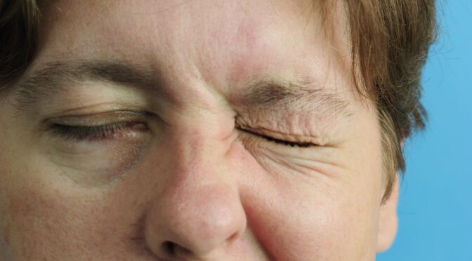 Bell’s Palsy/Facial Paralysis